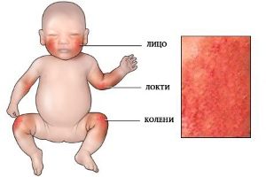 Возникновение аллергической реакции у новорожденного