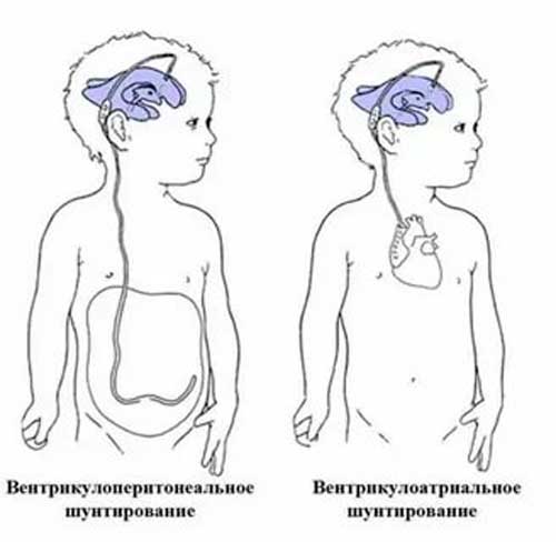 Шунтирование головного мозга при гидроцефалии