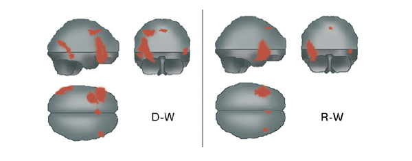 Статистически достоверные различия локального мозгового кровотока в сопоставлениях кровотока при выполнении испытуемыми вербальных тестов с различной креативной нагрузкой: D-W — разница в мозговом кровотоке при выполнении творческого задания по сравнению с нетворческим. R-W — разница в мозговом кровотоке при выполнении более трудного нетворческого задания по сравнению с более легким нетворческим заданием. Изображение: «Химия и жизнь»