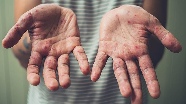 Сыпь на руках человека, болеющего корью («Коммерсантъ Наука» №13, апрель 2019)