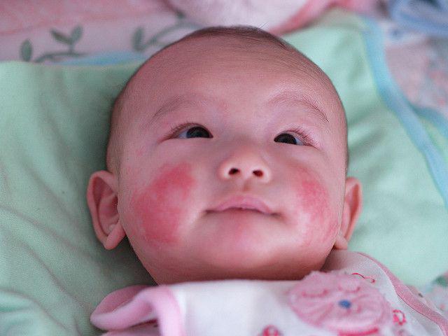 ребенку 5 месяцев красные щеки