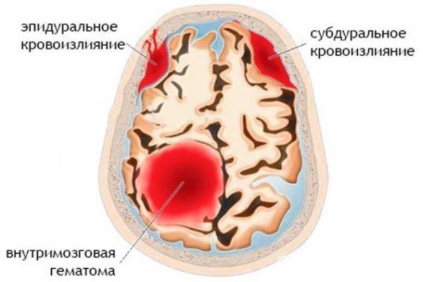 кровоизлияние в мозг