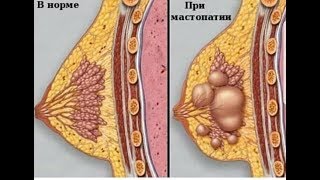Быстрое лечение лактостаза, мастита при грудном вскармливании