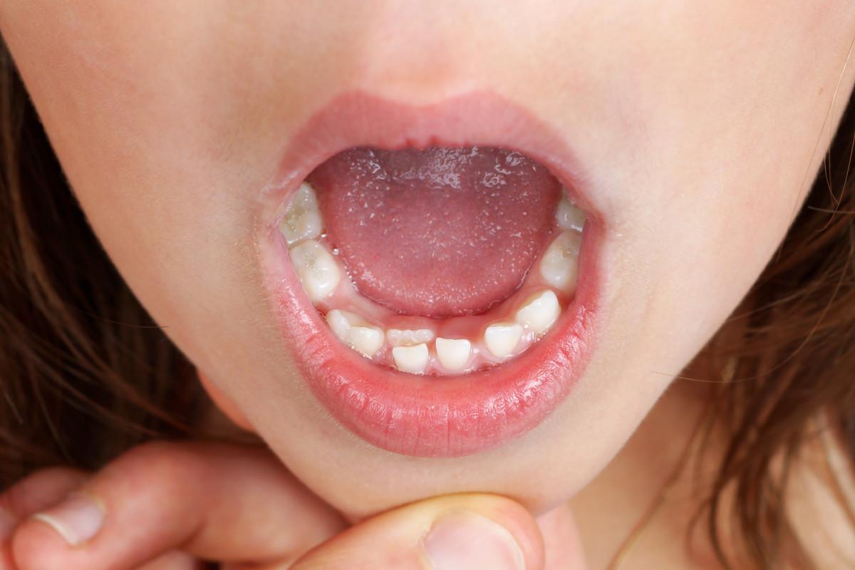 Постоянный зуб находится не на зубном ряде