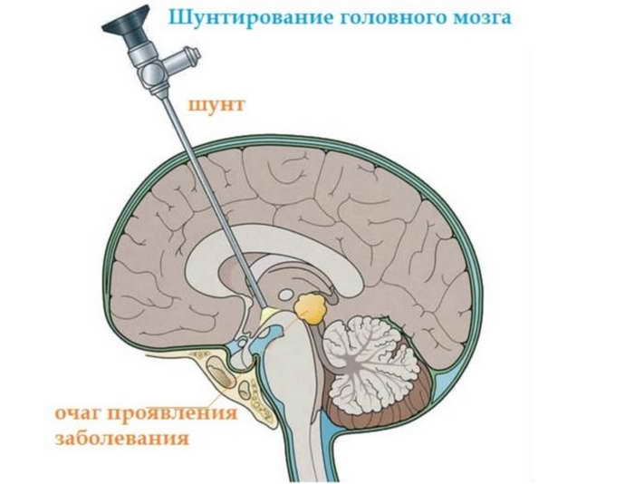 шунтирование мозга у детей