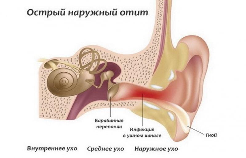 Острый наружный отит