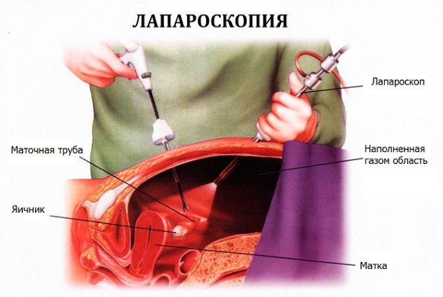 Лапароскопия при внематочной беременности