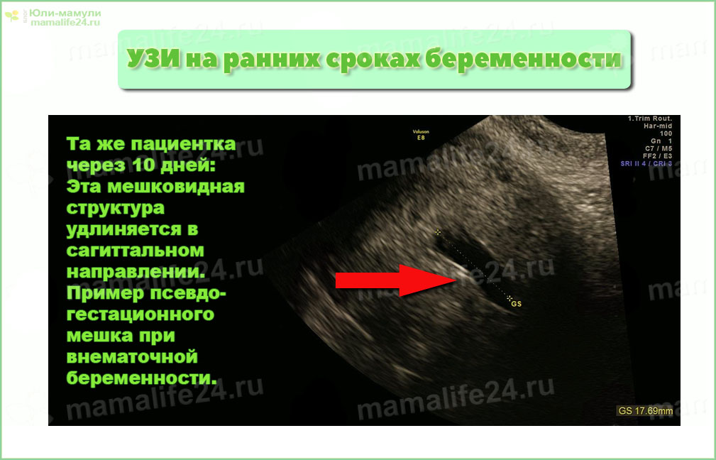 Псевдо-гестационный мешок у пациентки с внематочной беременностью - набор крови или жидкости, собранных в полости эндометрия. Этот псевдо мешок вытягивается в сагиттальном направлении.