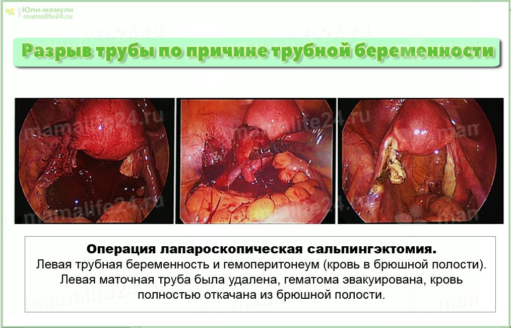 Разрыв трубы по причине трубной беременности операция сальпингэктомия