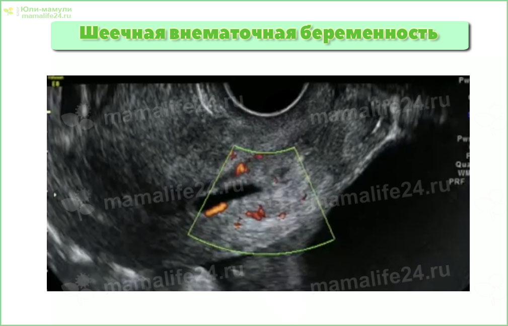 Шеечная внематочная беременность