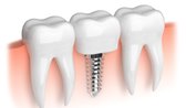 имплантация зубов "под ключ"