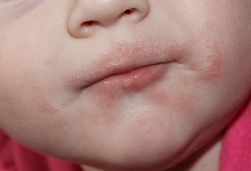 Аллергия на прикорм у ребенка