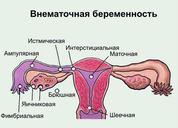 Что такое внематочная беременность и чем она опасна