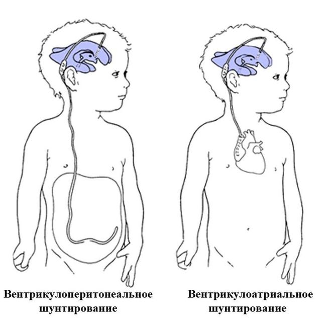 Шунтирование при гидроцефалии