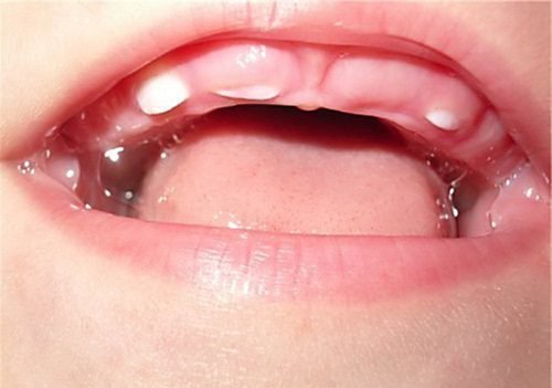 Прорезывание зубов у ребенка 
